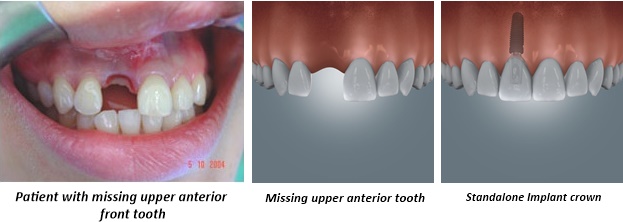 new-implant