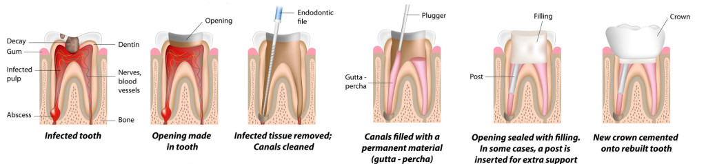 Root Canal Treatment Procedure