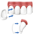 dental_veneers1