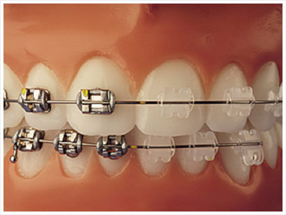 Sampl of Braces we can do