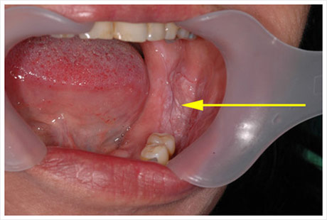 White Spots On Gums In Mouth 98